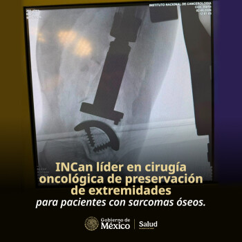 INCan líder en cirugía oncológica de preservación de extremidades para pacientes con sarcomas óseos